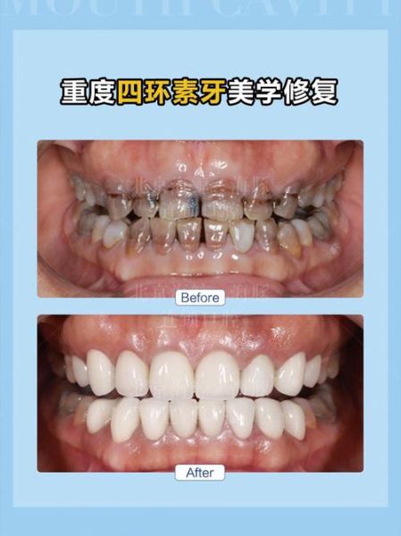 牙齿美学修复多少钱_牙齿美学修复能保持多久