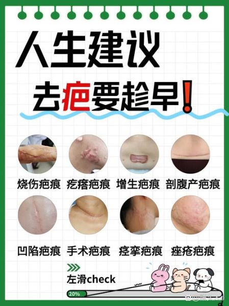 疤痕怎么淡化_疤痕修复最佳时间